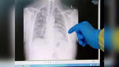या X-ray रिपोर्टमधून अवघ्या २ मिनिटात कोविडसह १४ आजारांची माहिती मिळवा