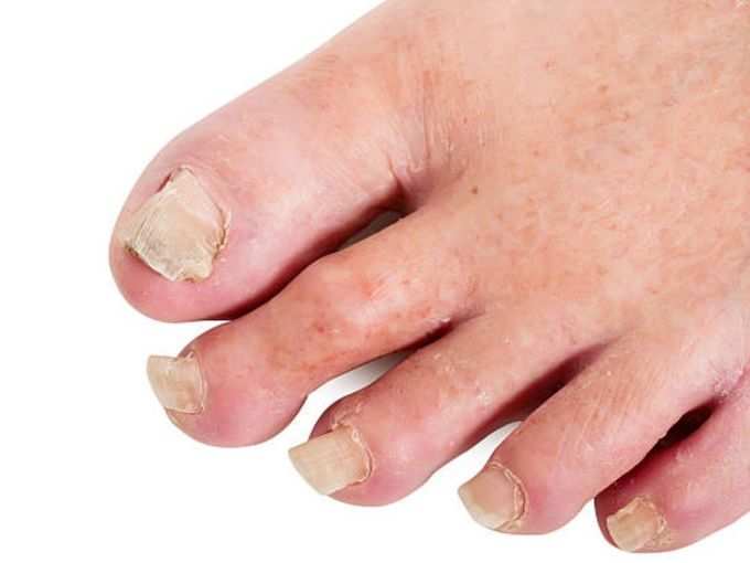 ​कोविड नेल्स (COVID nails) के सिम्टम्स