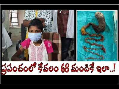 17 ఏళ్ల బాలికకు కడుపు నొప్పి.. టెస్ట్ చేసిన డాక్టర్లకే, షాక్.. ఏకంగా 2 కేజీల వెంట్రుకలు!