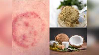 Ringworm Fungal Infection: फंगल इंफेक्शन के लिए रामबाण है नारियल का तेल और लहसुन का पेस्ट, इन 7 घरेलू नुस्खों से दूर होगी दाद