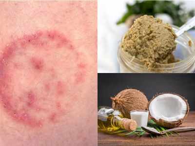 Ringworm Fungal Infection: फंगल इंफेक्शन के लिए रामबाण है नारियल का तेल और लहसुन का पेस्ट, इन 7 घरेलू नुस्खों से दूर होगी दाद