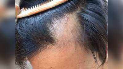 Covid Hair Fall: कोरोना से ठीक हुए मरीजों के अब उड़ रहे बाल, आसान है इसका इलाज; बस इन चीजों का रखना होगा ख्‍याल