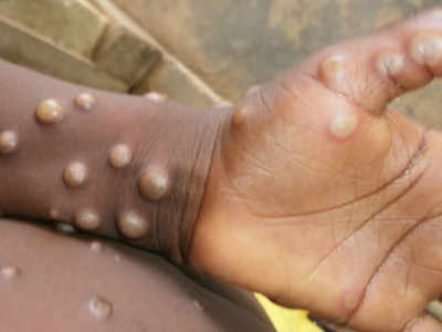 Monkeypox: अमेरिका में 20 साल बाद सामने आया मंकीपॉक्स का दुर्लभ केस, कितना खतरनाक?