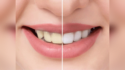 Teeth Whitening: चंद रोज में पाएं सफेद-चिट्टे दांत, चमचमाते दांतों का आयुर्वेदिक नुस्खा है ये घरेलू मंजन