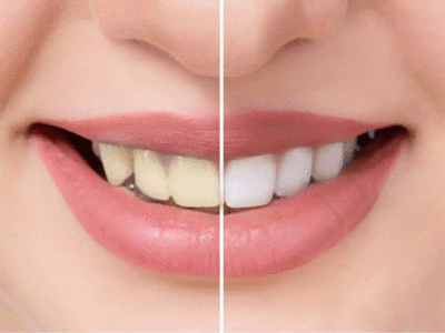 Teeth Whitening: चंद रोज में पाएं सफेद-चिट्टे दांत, चमचमाते दांतों का आयुर्वेदिक नुस्खा है ये घरेलू मंजन