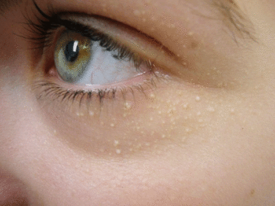 White Pimples Remedy: छत्ते के रूप में उगते हैं सफेद मुहांसे, आंख और नाक को बनाते हैं निशाना