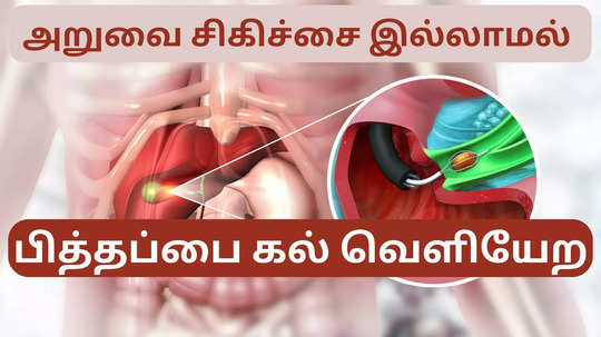 Gallbladder Stones:20  நாட்களில் பித்தப்பை கற்கள் வெளியேற்ற ஆயுர்வேத மருத்துவர் தரும் எளிய குறிப்பு!