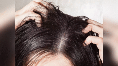 Hair Care: बालों से पूरी तरह साफ नहीं होता है डैंड्रफ तो ये तीन घरेलू तरीके जरूर ट्राई करें