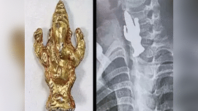 Medical Miracle: कर्नाटक में तीन साल के बच्चे ने निगली गणेश की मूर्ति, गले में फंसी... फिर डॉक्टरों ने ऐसे बचाई जान