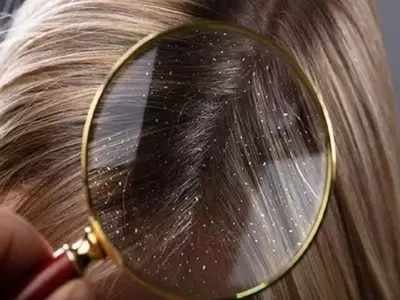 Dandruff remedies :பொடுகு நிரந்தரமா போக வேப்பிலை தான் பெஸ்ட், இப்படி பயன்படுத்துங்க? பாட்டிகால வைத்தியங்க!