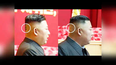 Kim Jong Un के सिर पर दिखा रहस्यमय गहरा निशान, पट्टी से छिपाने की कोशिश?