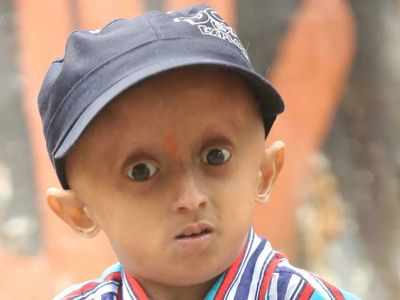 Rare disease: बच्चों को बूढ़ा बनाती है ये जानलेवा बीमारी, पर्दे पर अमिताभ बच्चन भी रह चुके Progeria Syndrome का शिकार