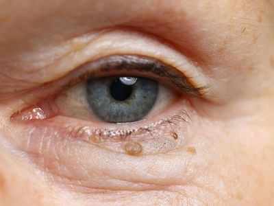 Cholesterol bumps: आंखों पर कोलेस्‍ट्रॉल जमा होने से भद्दा दिखने लगता चेहरा, 5 तरीके आजमाने से मिलेगा छुटकारा