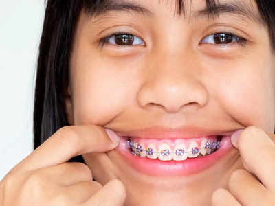 बच्‍चों के दांतों में तार लगवाने के बाद, की ऐसी गलती तो और टेढ़े हो जाएंगे दांत