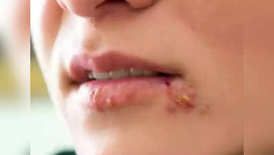 Cold Sores During Pregnancy : கர்ப்பிணிகளுக்கு வரும் குளிர் புண் என்றால் என்ன, எப்போது ஆபத்து?