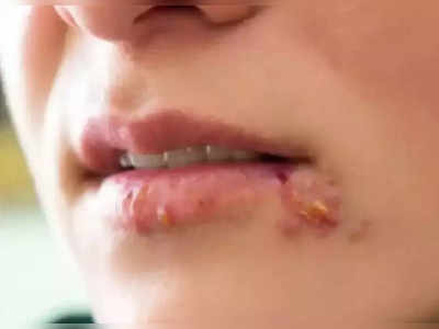 Cold Sores During Pregnancy : கர்ப்பிணிகளுக்கு வரும் குளிர் புண் என்றால் என்ன, எப்போது ஆபத்து?