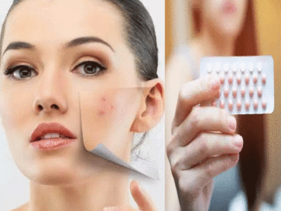 Birth Control Pills For Acne: कील-मुहांसों का पक्का इलाज हैं गर्भनिरोधक गोलियां, इन दो उम्र की महिलाएं ना करें सेवन