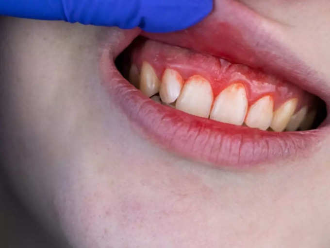 कमजोर दातों से एडल्ट्स लोगों में होने वाले लक्षण