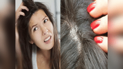 Hair Care Dandruff Cure Tips: इन पांच कारणों के चलते बार-बार लौट आता है डैंड्रफ, एक बार में करें पक्का समाधान