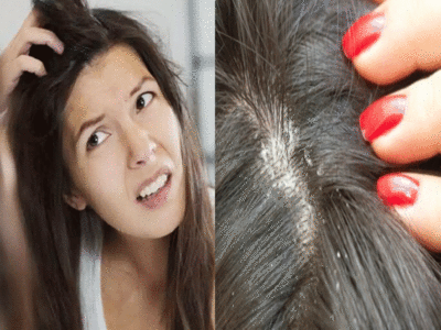 Hair Care Dandruff Cure Tips: इन पांच कारणों के चलते बार-बार लौट आता है डैंड्रफ, एक बार में करें पक्का समाधान