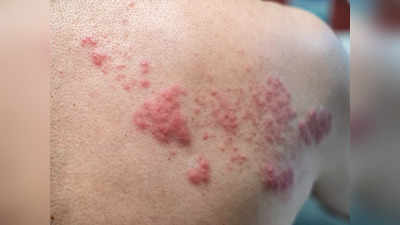 Skin fungal infection: केवल दाद-खुजली ही नहीं, स्‍किन पर होते हैं ये भयानक फंगल इंफेक्‍शन भी; ऐसे होता है उपचार