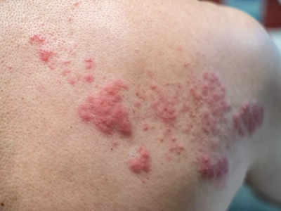 Skin fungal infection: केवल दाद-खुजली ही नहीं, स्‍किन पर होते हैं ये भयानक फंगल इंफेक्‍शन भी; ऐसे होता है उपचार