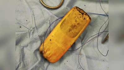 छह महीने से हो रहा था पेट में भयानक दर्द, ऑपरेशन कर निकाला गया भीतर फंसा मोबाइल