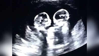 Video: मां के गर्भ में लड़ते दिखे जुड़वा बच्चे, लोगों को नहीं हो रहा यकीन!