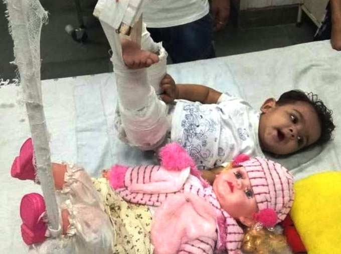 Delhi Doctors Put Plaster On Dolls Legs To Treat Toddlers Fractured Legs CM Arvind Kejriwal Praises