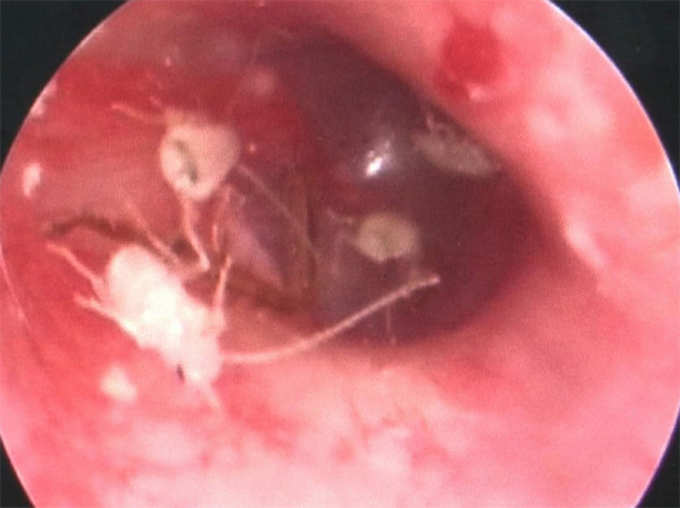 Man Had Family of Cockroaches Living Inside Ear Canal And Its Horrifying 