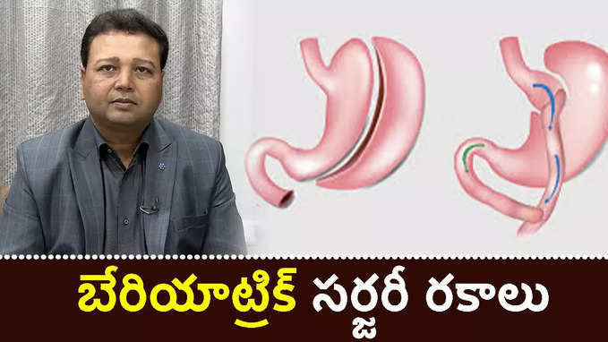 బేరియాట్రిక్ స‌ర్జ‌రీ ర‌కాలు 