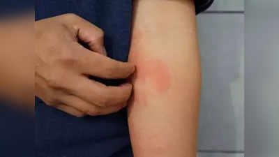 Skin Allergy : சருமத்தில் உண்டாகும் அலர்ஜிக்கு உதவும் வீட்டு வைத்தியம் !