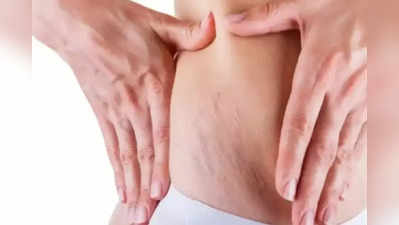 Red Stretch Marks : சிவப்பு நிற ஸ்ட்ரெச்மார்க் வருவதற்கு என்ன காரணம்?