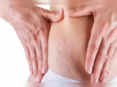 Red Stretch Marks : சிவப்பு நிற ஸ்ட்ரெச்மார்க் வருவதற்கு என்ன காரணம்?