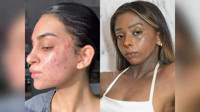 Scars Remedies : தோல்ல இருக்கிற தழும்பு வேகமா மறையணுமா ? இந்த நாலுல ஒரு எண்ணெய் யூஸ் பண்ணுங்க!