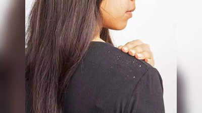 Winter Dandruff : குளிர்காலத்துல கண்டிப்பா பொடுகுத்தொல்லை வரும், தவிர்க்க இதை செய்யுங்க!