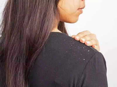 Winter Dandruff : குளிர்காலத்துல கண்டிப்பா பொடுகுத்தொல்லை வரும், தவிர்க்க இதை செய்யுங்க!