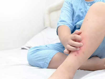 baby eczema : குழந்தைக்கு தோல் அழற்சி, அறிகுறிகளும் காரணங்களும்? பெற்றோர்களுக்கானது!