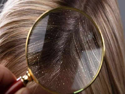 hair care tips: குளிர்காலத்தில் ஏன் அதிகமாக பொடுகு உண்டாகிறது?