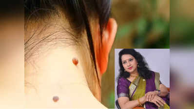 warts removing tips : மருக்கள் யாருக்கு அதிகமா வரும்? தொற்று நோயா? எப்படி, எப்போது நீக்குவது? நிபுணர் சொல்வது என்ன?