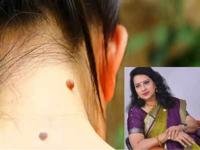 warts removing tips : மருக்கள் யாருக்கு அதிகமா வரும்? தொற்று நோயா? எப்படி, எப்போது நீக்குவது? நிபுணர் சொல்வது என்ன?