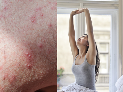 Skin Problem: अंडरआर्म्स के पिंपल्स से मिलेगी राहत, बस इन 5 बातों का रखें ख्याल
