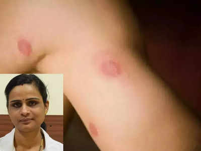 skin problems:  படர் தாமரை பிரச்சனைக்கு அதிமதுர வேர், எப்படி பயன்படுத்தணும்?