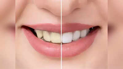 teethWhitening  : பற்கள் மஞ்சளா, கறைபடிஞ்சு இருந்தா வெள்ளையாக்க ஹைட்ரஜன் பெராக்சைடு இப்படி யூஸ் பண்ணுங்க!