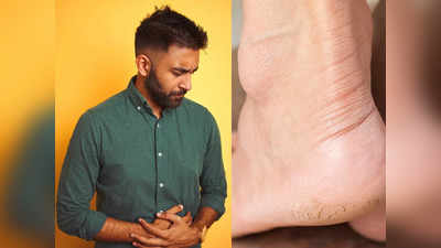 Cracked Heels Problem: आपकी फटी हुई एड़ियों से है पेट का गहरा नाता, डॉक्टर ने बताया दोनों के बीच का कनेक्शन