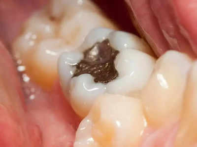 <strong>Natural remedies for cavities : </strong>दातांतील काळी कीड काढून टाकतील ‘हे’ 6 नैसर्गिक उपाय, वेदनांपासूनही होईल चुटकीसरशी मुक्ती! 