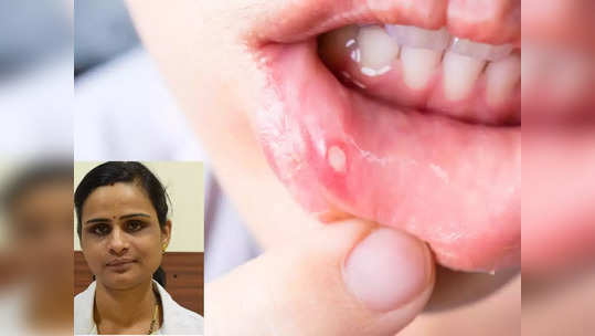 mouth ulcers remedis :  வாய்ப்புண்ணை சரி செய்யும் அற்புதமான மூலிகைகள், டாக்டர்  தரும் குறிப்புகள்!