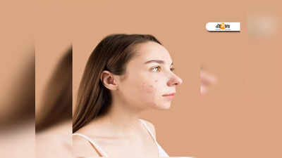 Winter Acne: শীতে বেড়েছে ব্রণর সমস্যা? সমাধান করুন এই উপায়ে