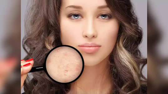 blind pimples  முகத்துல தெரியாத குருட்டு பருக்கள்,  இந்த நாலுல ஒண்ணு செய்யுங்க, காணாம போகும்!