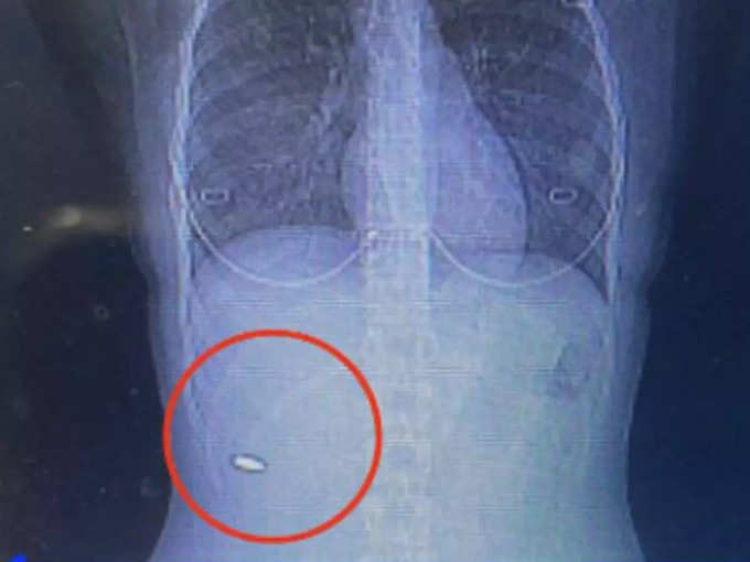woman hit by bullet three months befor but she did&#39;t knew new